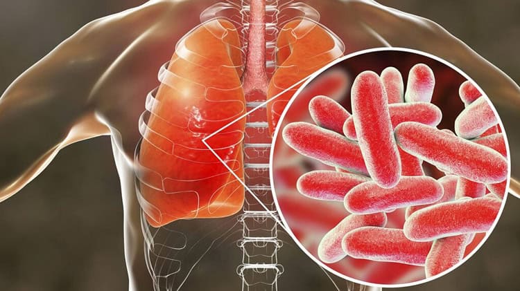 alerta-en-nueva-york-por-legionelosis-enfermedad-que-se-contagia-por-el-agua-y-no-tiene-vacuna-2-1544e2c4