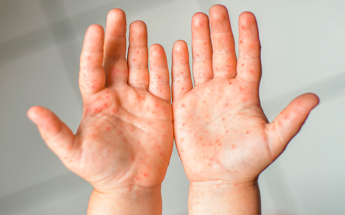 Sarampion-causas-mexico-10042024